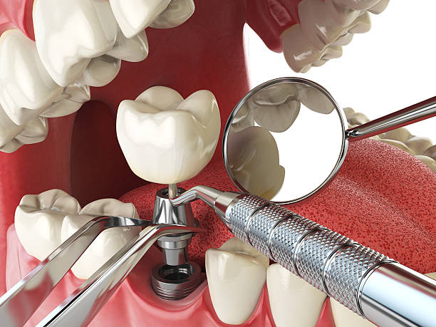 Best Urgent Tooth Repair  in Fort Llins, CO